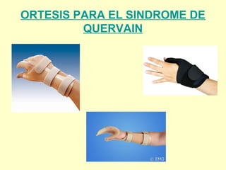 ORTESIS PARA EL SINDROME DE
QUERVAIN
 