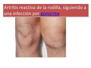Artritis reactiva de la rodilla, siguiendo a
una infección por gonorrea
 