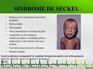 Secke Sindrome de seckel thalia | PPTX