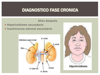 Años después.
 Hipotiroidismo secundario
 Insuficiencia adrenal secundario
 