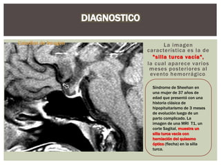 La imagen
característica es la de
"silla turca vacía",
la cual aparece varios
meses posteriores al
evento hemorrágico.
Síndrome de Sheehan en
una mujer de 37 años de
edad que presentó con una
historia clásica de
hipopituitarismo de 3 meses
de evolución luego de un
parto complicado. La
imagen de una MRI T1, un
corte Sagital, muestra un
silla turca vacía con
herniación del quiasmo
óptico (flecha) en la silla
turca.
 