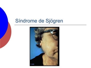 Síndrome de Sjögren
 