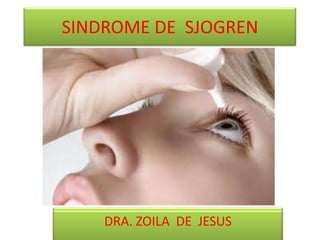 SINDROME DE SJOGREN




    DRA. ZOILA DE JESUS
 