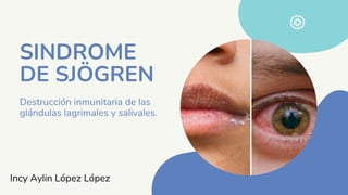 Destrucción inmunitaria de las
glándulas lagrimales y salivales.
SINDROME
DE SJÖGREN
Incy Aylin López López
 