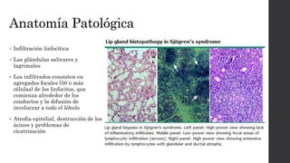 Anatomía Patológica
 Infiltración linfocítica
 Las glándulas salivares y
lagrimales
 Los infiltrados consisten en
agregados focales (50 o más
células) de los linfocitos, que
comienza alrededor de los
conductos y la difusión de
involucrar a todo el lóbulo
 Atrofia epitelial, destrucción de los
ácinos y problemas de
cicatrización
 