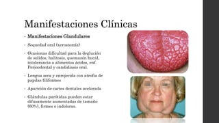 Manifestaciones Clínicas
• Manifestaciones Glandulares
• Sequedad oral (xerostomía)
• Ocasionas dificultad para la deglución
de solidos, halitosis, quemazón bucal,
intolerancia a alimentos ácidos, enf.
Perioodontal y candidiasis oral.
• Lengua seca y enrojecida con atrofia de
papilas filiformes
• Aparición de caries dentales acelerada
• Glándulas parótidas pueden estar
difusamente aumentadas de tamaño
(60%), firmes e indoloras.
 