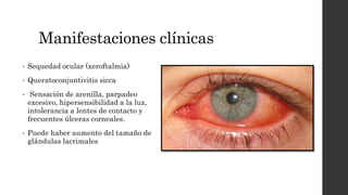 Manifestaciones clínicas
• Sequedad ocular (xeroftalmia)
• Queratoconjuntivitis sicca
• Sensación de arenilla, parpadeo
excesivo, hipersensibilidad a la luz,
intolerancia a lentes de contacto y
frecuentes úlceras corneales.
• Puede haber aumento del tamaño de
glándulas lacrimales
 