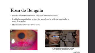 Rosa de Bengala
• Tiñe los filamentos mucosos y las células desvitalizadas
• Evalúa la capacidad de protección que ofrece la película lagrimal a la
superficie ocular
• El colorante teñirá las áreas secas
 
