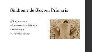 Síndrome de Sjogren Primario
• Síndrome seco.
• Queratoconjuntivis seca
• Xerostomia
• Con curso aislado
 