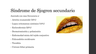 Síndrome de Sjogren secundario
Asociado con mas frecuencia a:
• Artritis reumatoide (30%)
• Lupus eritematoso sistémico (10%)
• Esclerodermia (20%)
• Dermatomiositis y polimiositis
• Enfermedad mixta del tejido conjuntivo
• Policondritis recidivante
• Tiroiditis
• Cirrosis biliar primaria
 