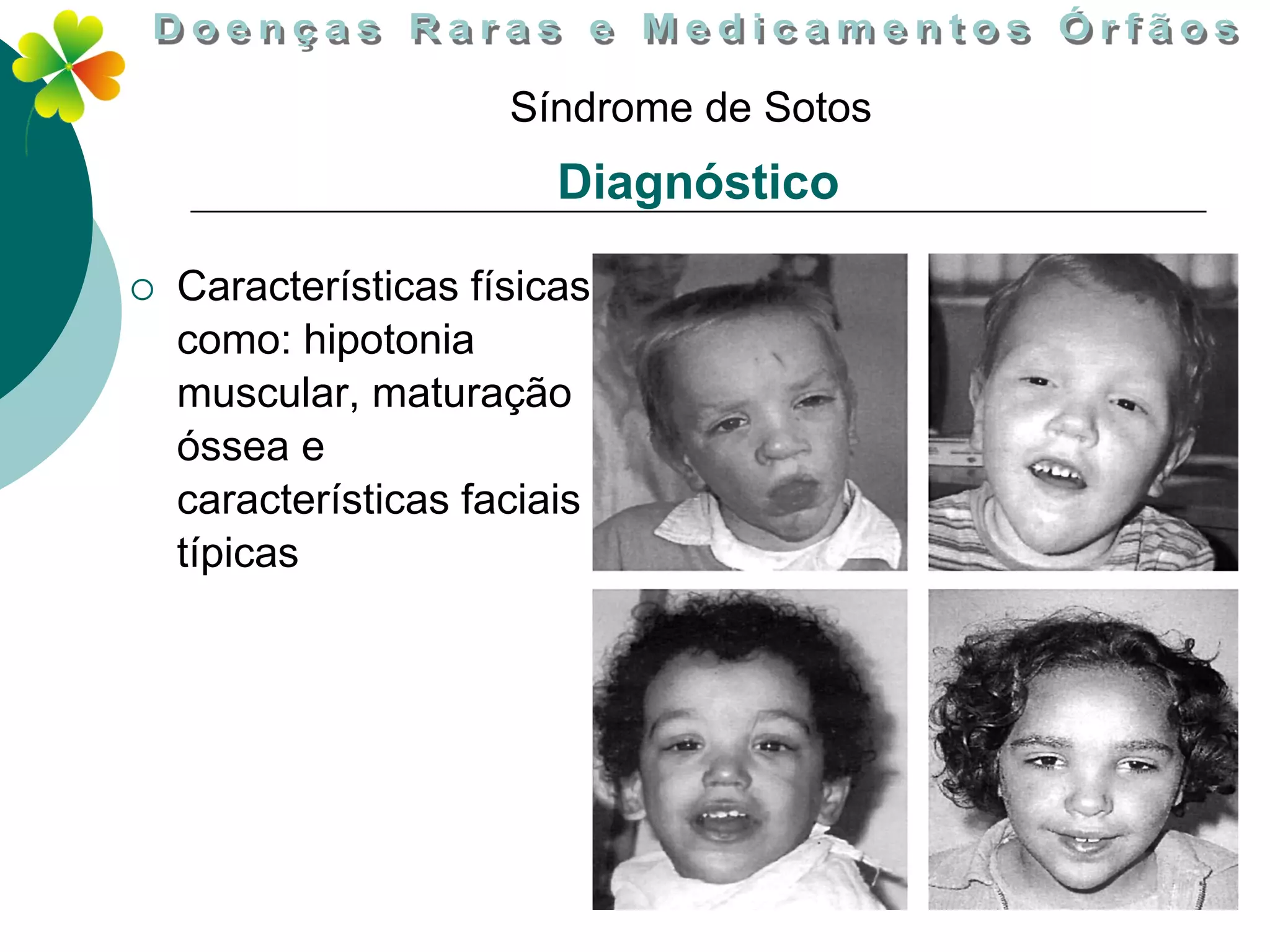 Sindrome de sotos