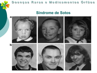Síndrome de Sotos
 
