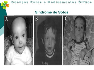Síndrome de Sotos
 