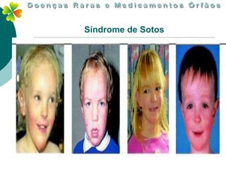 Síndrome de Sotos
 