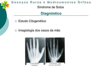 Síndrome de Sotos

                   Diagnóstico

   Estudo Citogenético

   Imagiologia dos ossos da mão
 