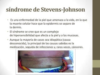 síndrome de Stevens-Johnson
• Es una enfermedad de la piel que amenaza a la vida, en la que
  la muerte celular hace que la epidermis se separe de
  la dermis.
• El síndrome se cree que es un complejo
  de hipersensibilidad que afecta a la piel y a las mucosas.
• Aunque la mayoría de casos sea idiopática (causa
  desconocida), la principal de las causas sabidas es la
  medicación, seguida de infecciones y, raras veces, cánceres.
 
