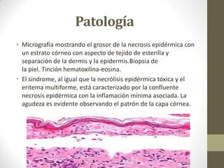 Patología
• Micrografía mostrando el grosor de la necrosis epidérmica con
  un estrato córneo con aspecto de tejido de esterilla y
  separación de la dermis y la epidermis.Biopsia de
  la piel. Tinción hematoxilina-eosina.
• El síndrome, al igual que la necrólisis epidérmica tóxica y el
  eritema multiforme, está caracterizado por la confluente
  necrosis epidérmica con la inflamación mínima asociada. La
  agudeza es evidente observando el patrón de la capa córnea.
 