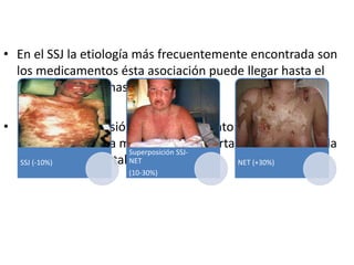 • En el SSJ la etiología más frecuentemente encontrada son
los medicamentos ésta asociación puede llegar hasta el
50% y en la NET hasta el 80%.
• La rápida suspensión del medicamento involucrado es
probablemente la medida más importante para reducir la
morbilidad y mortalidad.SSJ (-10%)
Superposición SSJ-
NET
(10-30%)
NET (+30%)
 