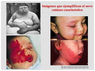 Imágenes que ejemplifican el nevo
     cutáneo característico




            http://www.uv.es/derma/CLindex/CLtumb/CLtumbe24.html
            http://www.uv.es/derma/CLindex/CLtumb/CLtumbe21.html
 