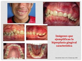 Imágenes que
  ejemplifican la
hiperplasia gingival
    característica



   Acta odontol. Venez v.44 n.2 Caracas ago. 2006
 
