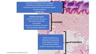 Sindrome de Sweet diagnostico y tratamiento.pdf