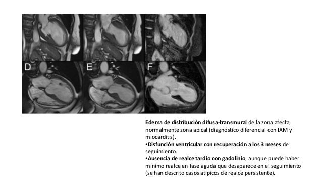 Sindrome Di Tako Tsubo Si Guarisce