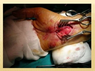 Tratamiento Kinésico Masaje : el cual sirve para  liberar las adherencias  del nervio medianoCrioterapia: trabajo manual, es la aplicación de frío sobre el organismoLáser :  el cual acelera el proceso de cicatrización, disminuyendo  el edema y provocando analgesiaUltrasonidos :para elimina adherencias internas Electroestimulación : fortalece  los flexores de muñeca y dedos.Realizar ejercicios de estiramiento de la articulación Reeducación de la funcionalidad de la mano.