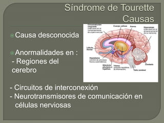 Sindrome de tourette . p p t | PPSX