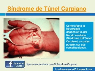 Síndrome de Túnel Carpiano
Como afecta la
Neuropatía
degenerativa del
Nervio mediano
(Síndrome del Túnel
Carpiano) y cuales
pueden ser sus
complicaciones.
https://www.facebook.com/NoMasTunelCarpiano
 