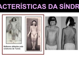 ACTERÍSTICAS DA SÍNDR
 