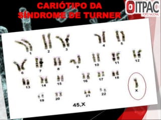 CARIÓTIPO DA
SÍNDROME DE TURNER
 