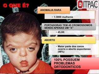 O QUE É?
100% POSSUEM
PROBLEMAS
ORTODONTICOS
• 45,X0;
PORTADORAS TEM 45 CROMOSSOMOS
SENDO APENAS UM “X”
• 1:3000 mulheres
• Maior parte dos casos
ocorre o aborto espontaneo
(98%)
ABORTO
ANOMALIA RARA
 
