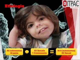 Etiologia
AA autossomos
44 pares
XX Sexuais
1 Cromossomo
44 A (autossomos)
X0 Sexual
 