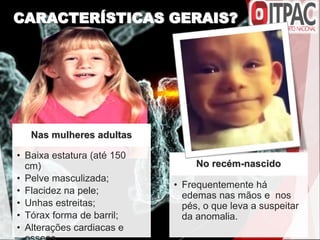 CARACTERÍSTICAS GERAIS?
Nas mulheres adultas
• Baixa estatura (até 150
cm)
• Pelve masculizada;
• Flacidez na pele;
• Unhas estreitas;
• Tórax forma de barril;
• Alterações cardiacas e
No recém-nascido
• Frequentemente há
edemas nas mãos e nos
pés, o que leva a suspeitar
da anomalia.
 