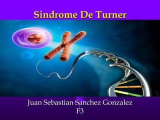 Sindrome De Turner
Juan Sebastian Sanchez Gonzalez
F3
 