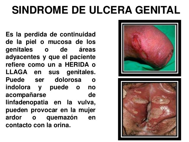 Sindrome De Ulcera Genital