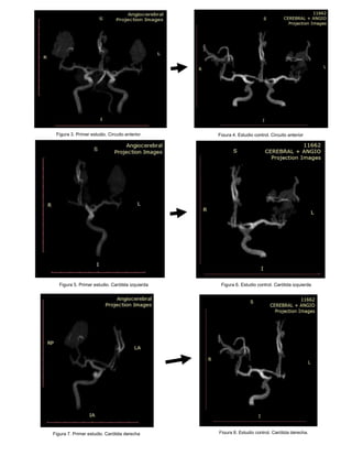Figura 6. Estudio control. Carótida izquierda
Figura 3. Primer estudio. Circuito anterior Figura 4. Estudio control. Circuito anterior
Figura 5. Primer estudio. Carótida izquierda
Figura 7. Primer estudio. Carótida derecha Figura 8. Estudio control. Carótida derecha.
 