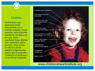 Físicas
Suelen tener una
apariencia facial
denominada élfica,
mentón pequeño, frente
estrecha, nariz pequeña,
hinchazón alrededor de
los ojos, surco
nasolabial largo, dientes
muy separados, labios
gruesos y boca ancha.
La estatura de los
adultos es ligeramente
menor que la promedio.
Tendencia al zurdismo y
al uso del ojo izquierdo
www.childrensheartinstitute.org
 