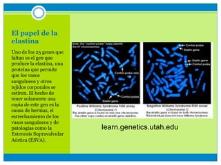 El papel de la
elastina
Uno de los 25 genes que
faltan es el gen que
produce la elastina, una
proteína que permite
que los vasos
sanguíneos y otros
tejidos corporales se
estiren. El hecho de
tener solamente una
copia de este gen es la
causa de hernias, el
estrechamiento de los
vasos sanguíneos y de
patologías como la
Estenosis Supravalvular
Aórtica (ESVA).
learn.genetics.utah.edu
 