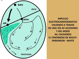 IMPULSOELECTROCARDIOGRAFICOVIAJANDO A TRAVESDE UNA VÍA AV ACCESORIAY DEL NODO AV, CAUSANDO EL FENOMENO DE WOLFF-PARKINSON - WHITE