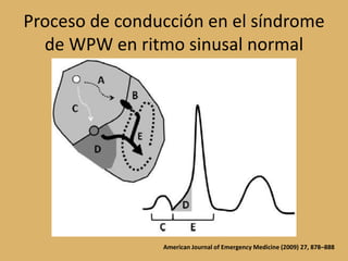 Proceso de conducción en el síndrome de WPW en ritmo sinusal normalAmerican Journal of Emergency Medicine (2009) 27, 878–888