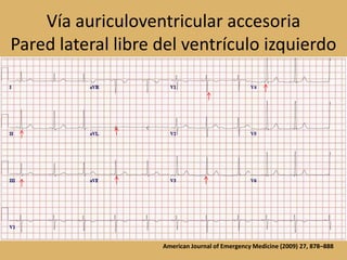 Vía auriculoventricular accesoriaPared lateral libre del ventrículo izquierdoAmerican Journal of Emergency Medicine (2009) 27, 878–888