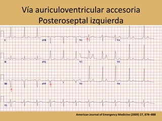 Vía auriculoventricular accesoriaPosteroseptal izquierdaAmerican Journal of Emergency Medicine (2009) 27, 878–888