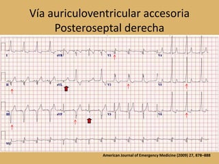 Vía auriculoventricular accesoriaPosteroseptal derechaAmerican Journal of Emergency Medicine (2009) 27, 878–888