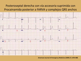 Posteroseptal derecha con vía accesoria suprimida con Procainamida posterior a FARVA y complejos QRS anchosAmerican Journal of Emergency Medicine (2009) 27, 878–888