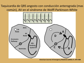 Taquicardia de QRS angosto con conducción anterograda (mas común), AV en el síndrome de Wolff-Parkinson-WhiteAmerican Journal of Emergency Medicine (2009) 27, 878–888
