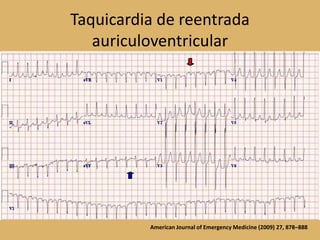 Taquicardia de reentradaauriculoventricularAmerican Journal of Emergency Medicine (2009) 27, 878–888
