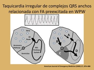 Taquicardia irregular de complejos QRS anchos relacionada con FA preexcitada en WPWAmerican Journal of Emergency Medicine (2009) 27, 878–888