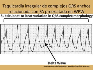 Taquicardia irregular de complejos QRS anchos relacionada con FA preexcitada en WPWAmerican Journal of Emergency Medicine (2009) 27, 878–888