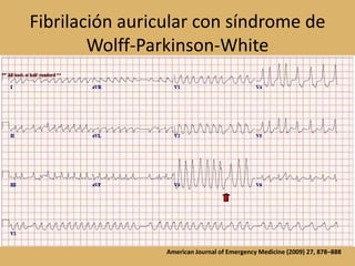 Fibrilación auricular con síndrome de Wolff-Parkinson-WhiteAmerican Journal of Emergency Medicine (2009) 27, 878–888